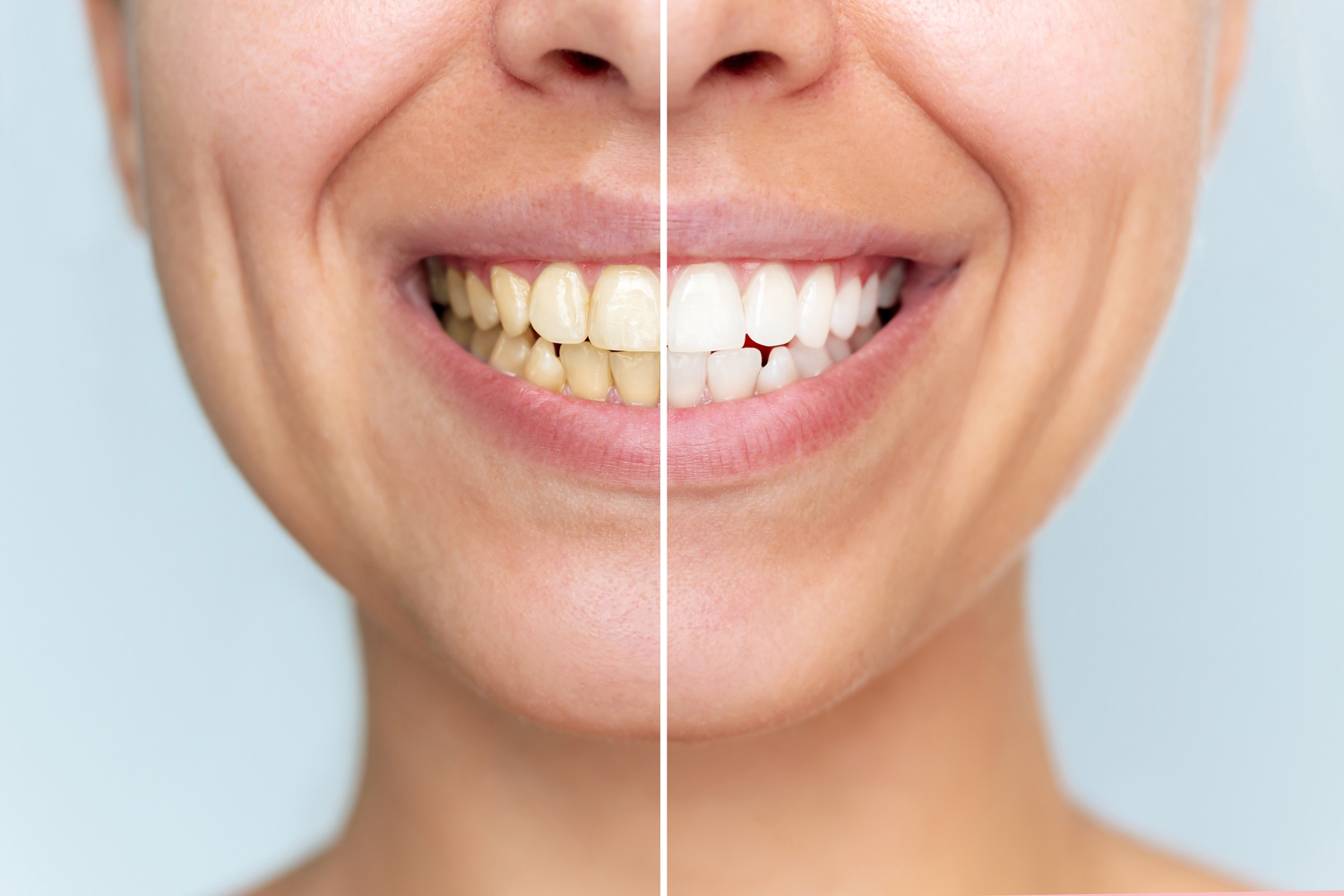 Young woman before and after teeth whitening close-up. Half-smile comparison showing stained teeth versus bright white teeth. Dental care, oral hygiene, healthy smile concept