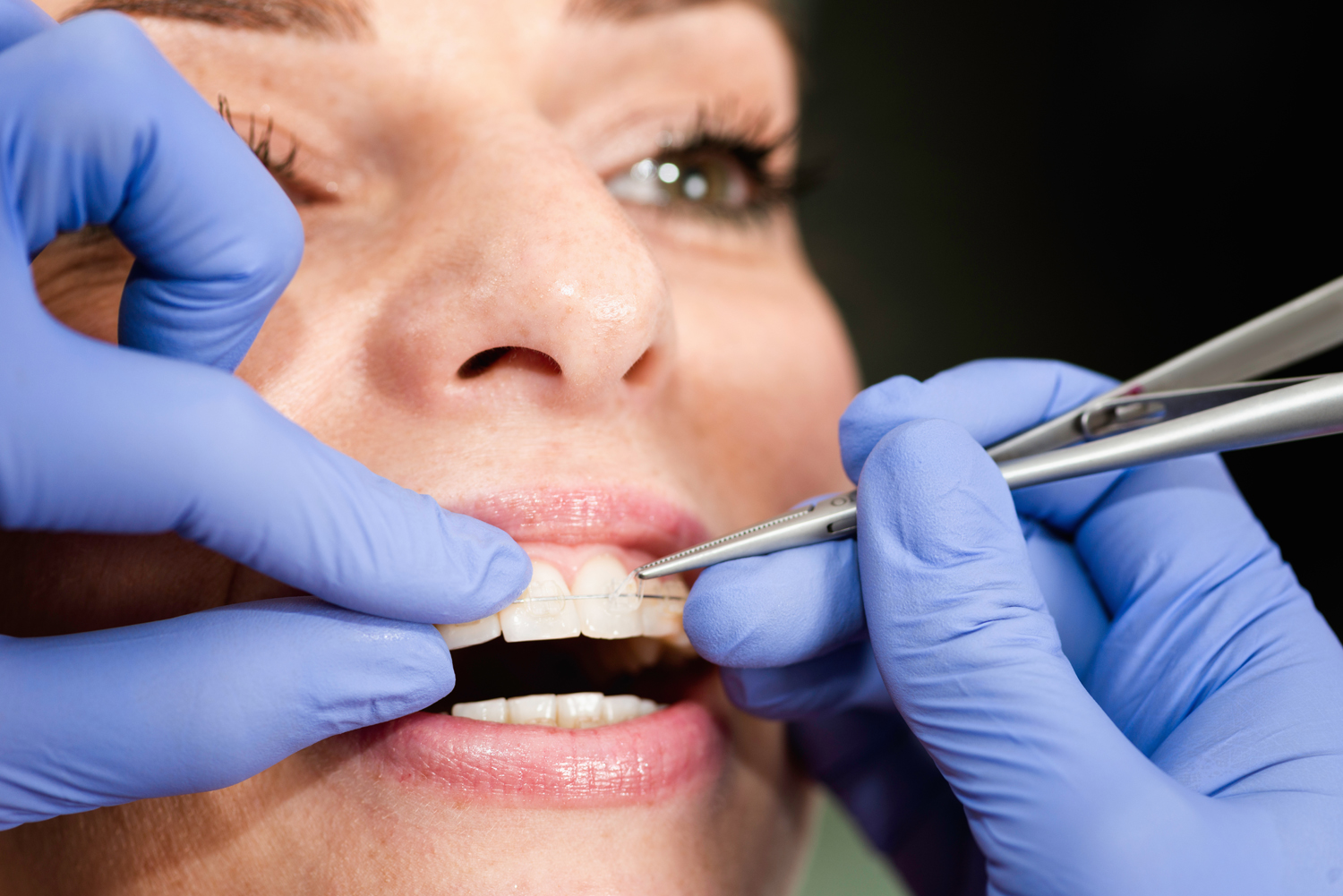 Orthodontist fixing invisible ceramic braces