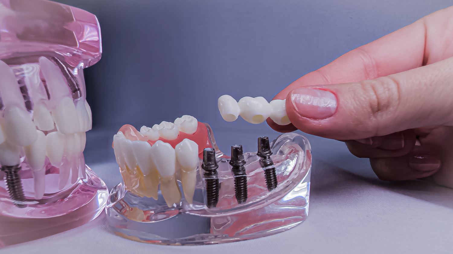Dental implant model with abutments while hand places ceramic bridge onto implants Demonstration of implant supported prosthetics used for patient education and treatment planning Concept of dental