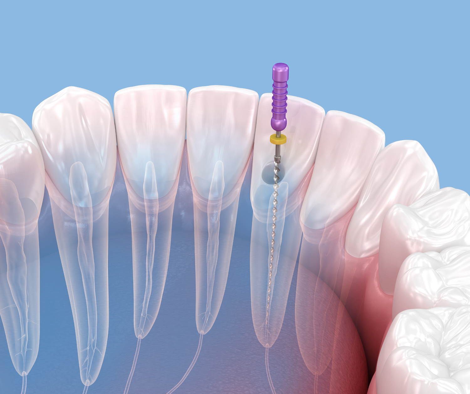 Endodontic root canal treatment process. Medically accurate tooth 3D illustration.