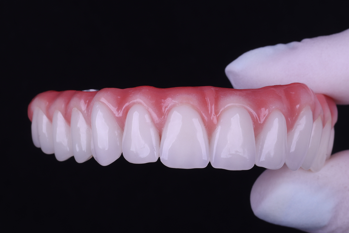 Prosthesis dental implants in acrylic resin