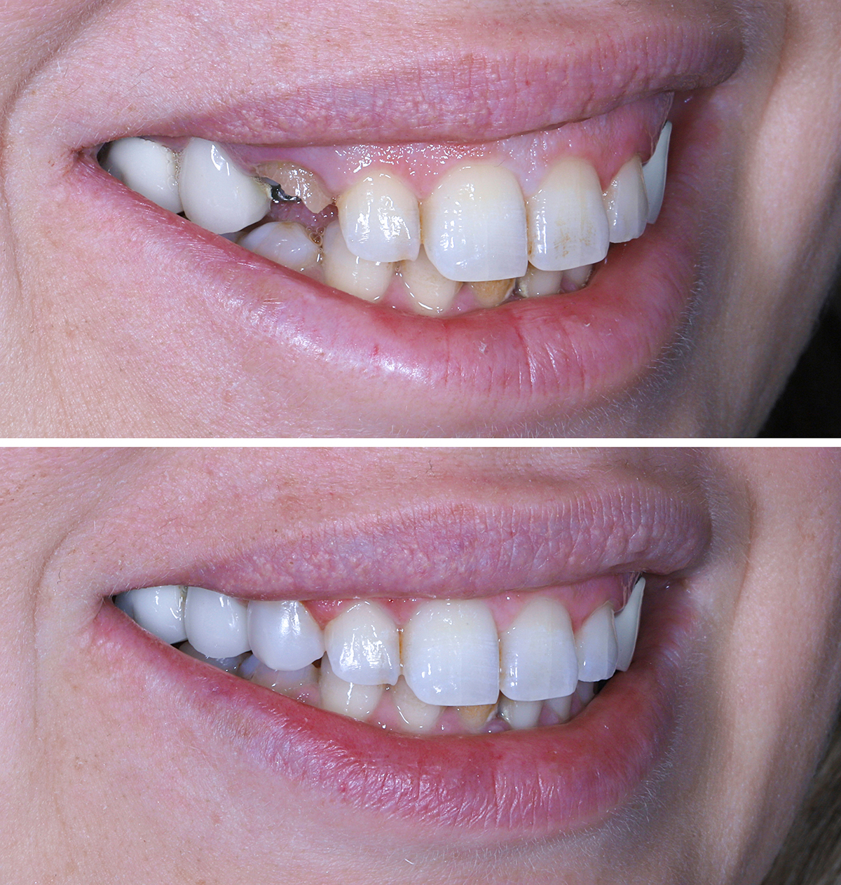 Restoration of decayed and broken teeth with white aesthetic filling in dental dentistry. Composite filling treatment, also known as aesthetic filling. Dental before and after. Smile makeover.