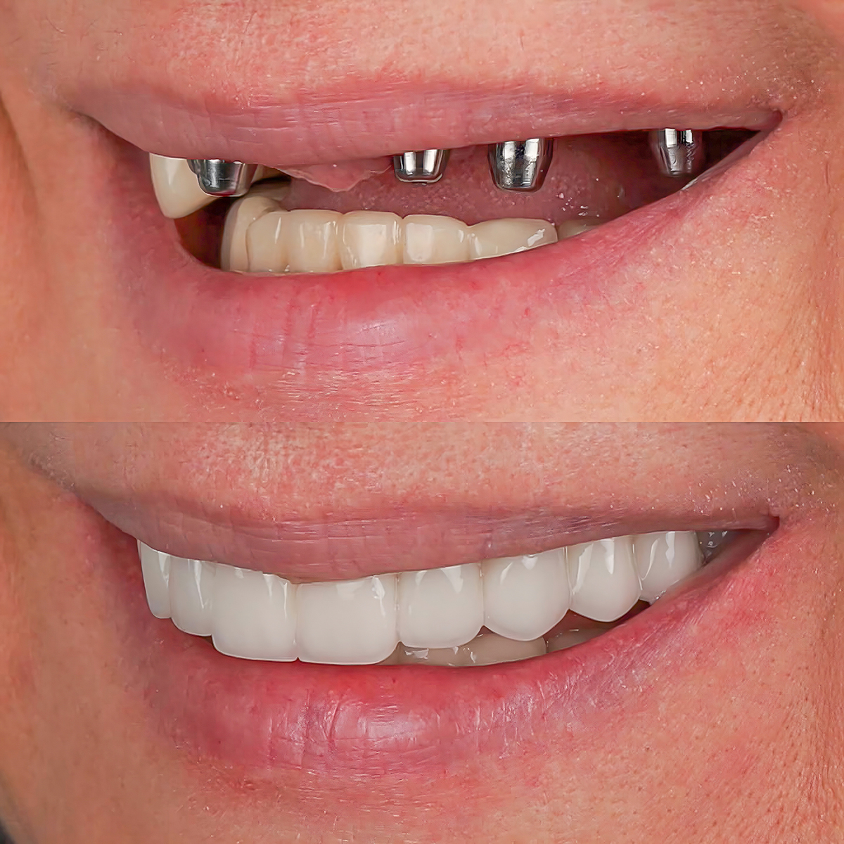 Full jaw dental prosthesis in people with no teeth. Dental implant treatment all-on-four, all-on-X, and all-on-4 implant treatment before and after intraoral photo of full jaw hybrid dental prosthesis