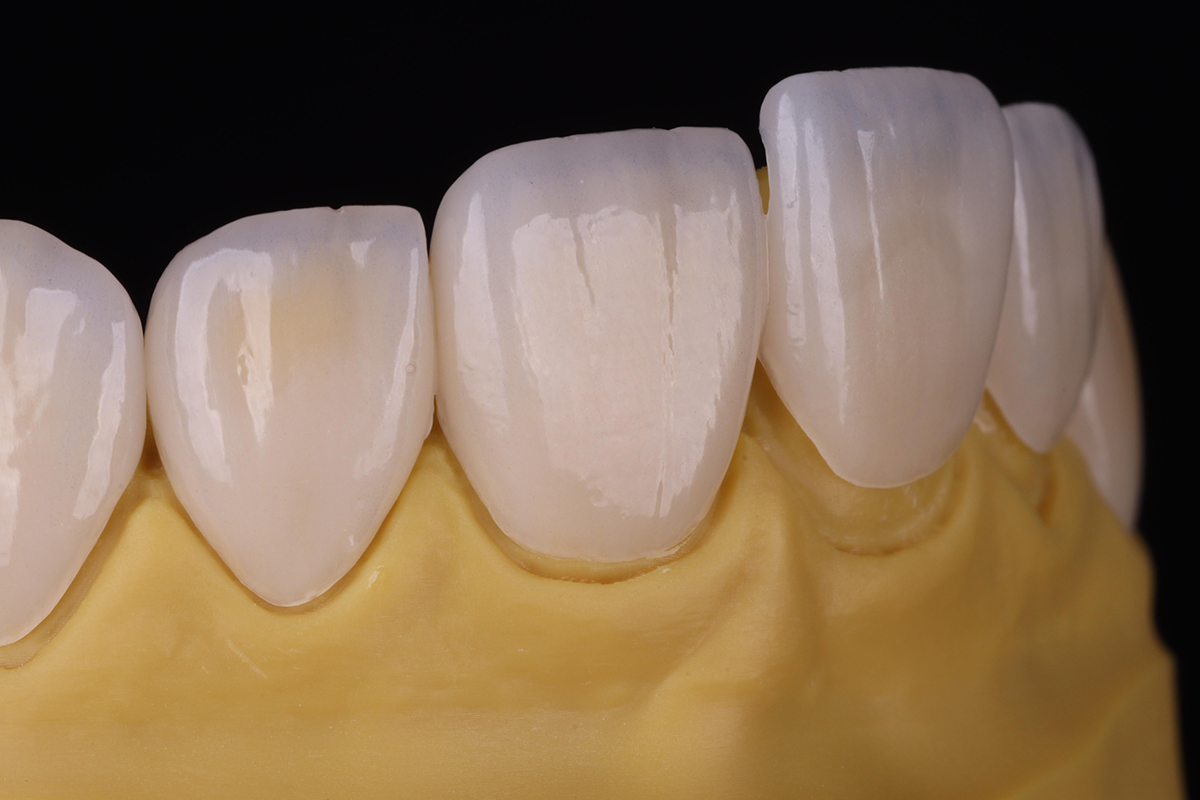 Ceramic veneers aesthetic dental 3d printing